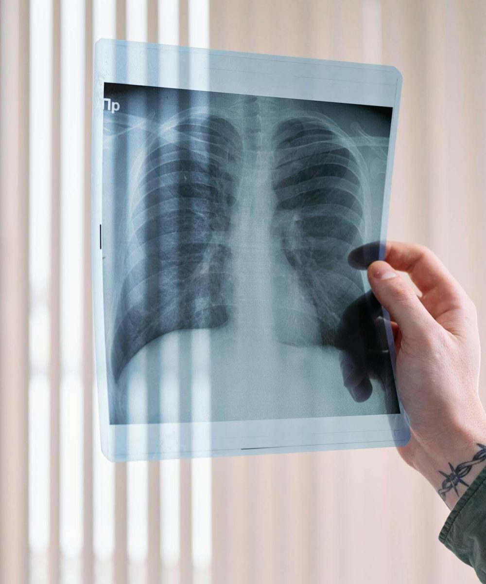 Tuberculosis Screening